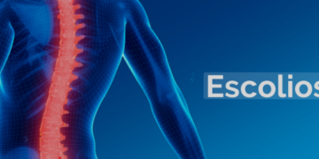 Projeto de Max Lemos obriga SUS fornecer colete ortopédico para tratar escoliose idiopática