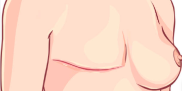 Comissão de Educação aprova acompanhante para paciente em tratamento de câncer em hospitais