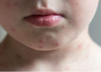 Leo Prates propõe incluir vacina contra herpes zoster no calendário de vacinação da saúde pública