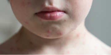 Leo Prates propõe incluir vacina contra herpes zoster no calendário de vacinação da saúde pública